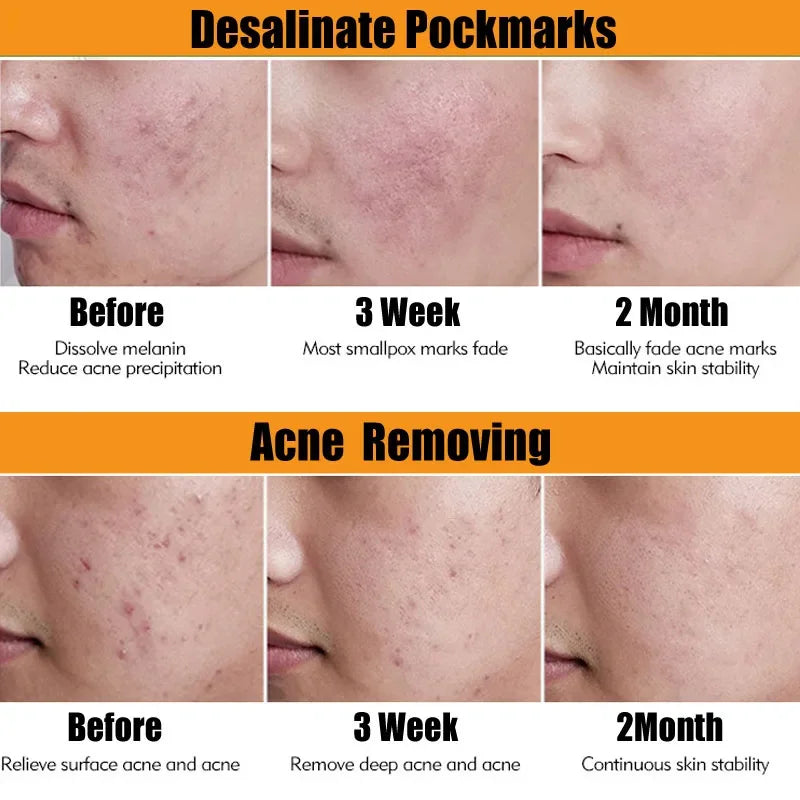 Paradise Divas tea tree acne removal serum for a clear, blemish-free complexion
