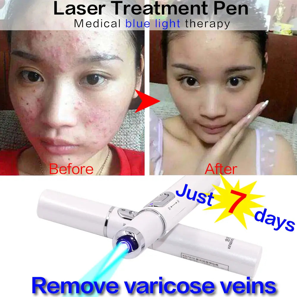 Paradise Divas Blue Light Facial Machine for Acne and Wrinkle Removal with Laser Pen
